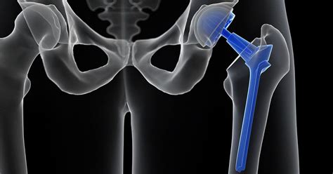 hip surgery greenwich|Orthopaedics in Lewisham .